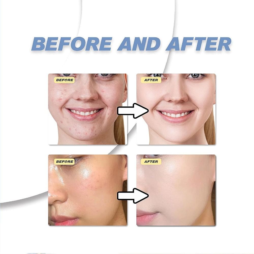 Azelaic Acid 12% 20% Serum Aze - Azelaic Acid Serum recension och pris