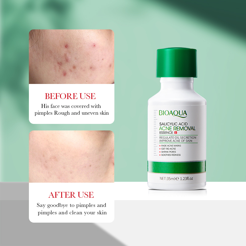 35ml BIOAOUA Salicylic Acid An - Azelaic Acid Serum recension och pris