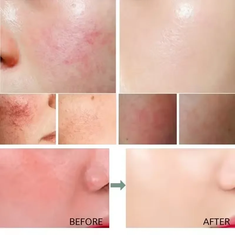 Facial Redness Repair Cream Im - Coenzyme Q10 Cream recension och pris