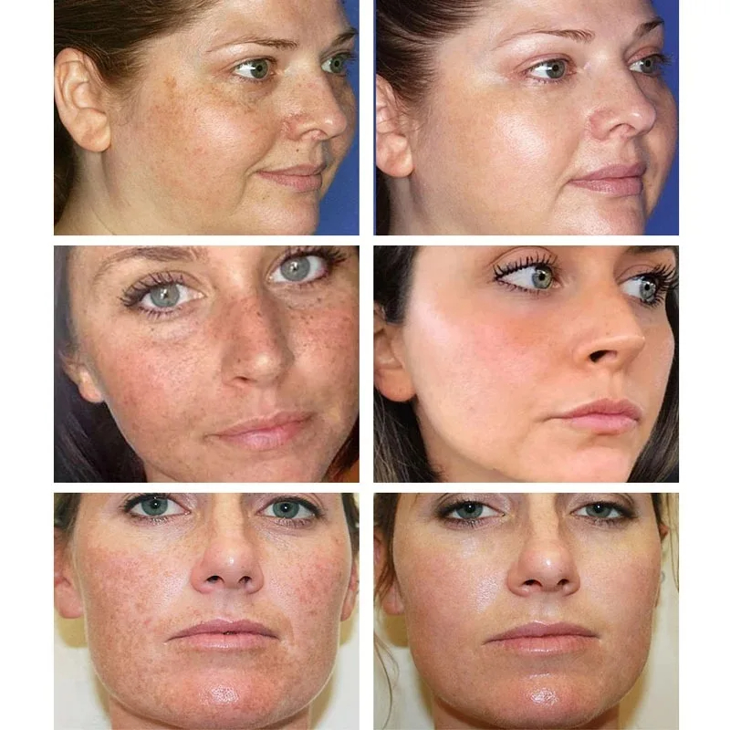 Whitening Freckle Cream Remove - Skincare Glowing recension och pris