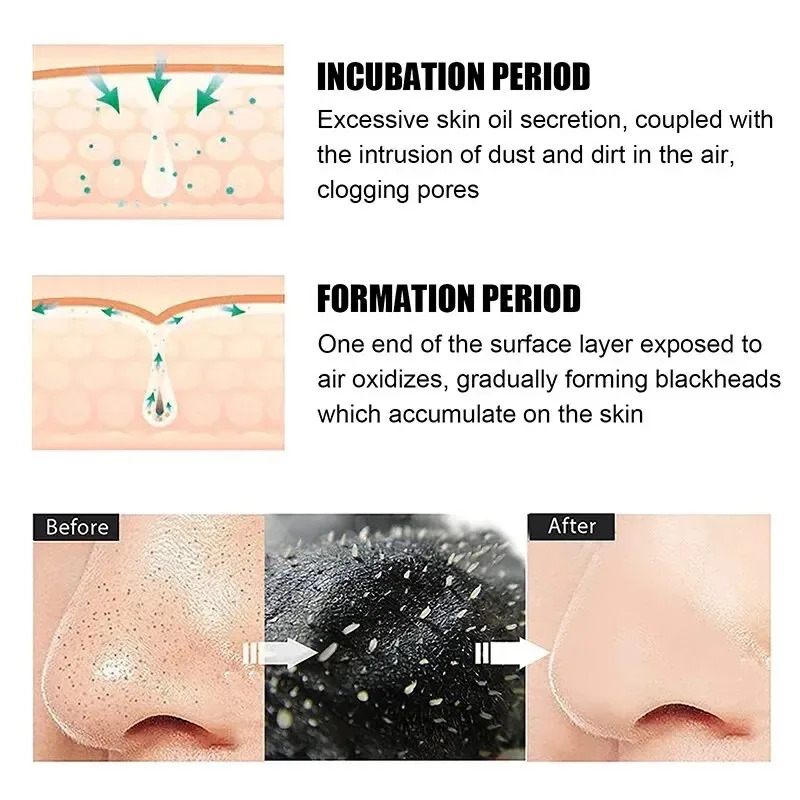 10/150PCS Blackhead Remove Mas - Skincare Finally Found You recension och pris